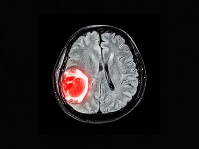 نابود کردن تومورهای مغزی با داروی اسکیزوفرنی